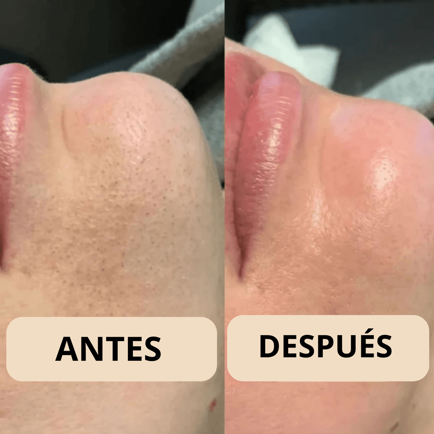 Peel Shot Coreano - Elimina las Impurezas y Sublima tu Piel