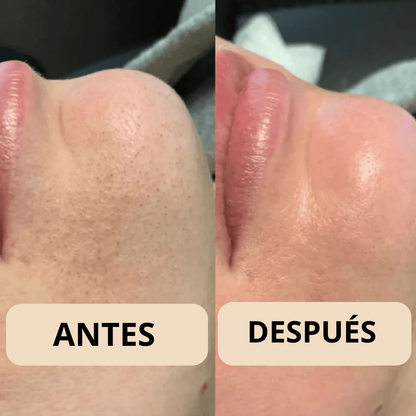 Peel Shot Coreano - Elimina las Impurezas y Sublima tu Piel