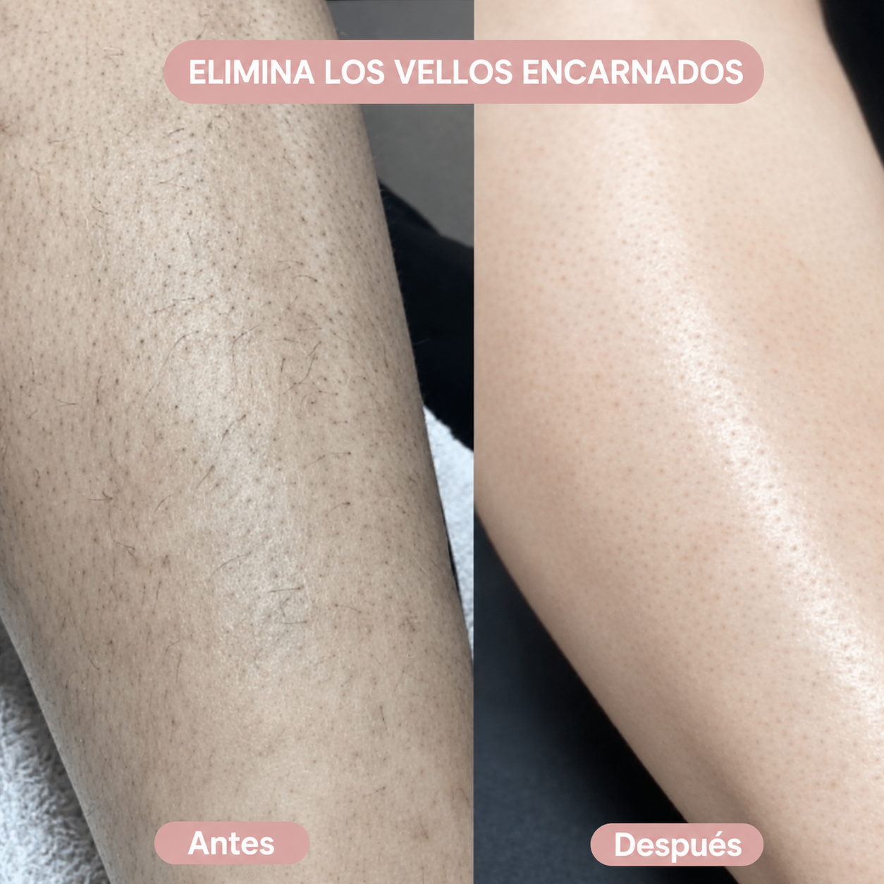 Seraskin™ – Depiladora 2 en 1 para Bikini y Cuerpo